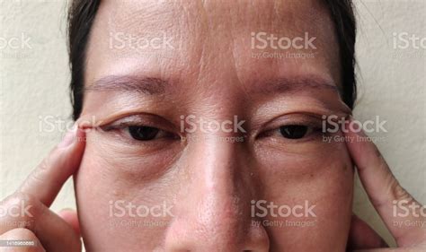 The Flabbiness Adipose Sagging Skin Beside The Eyelid Flabby Skin And