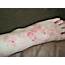 Izaiahs Scroll Dermatologist/ Hospital Stay/ Healing Eczema IV