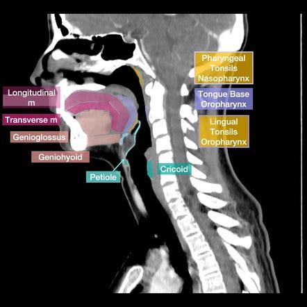 Adenoid Tonsil Radiology Reference Article Radiopaedia Org