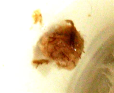 Eggs of hookworm in stool. Can anyone tell me what this is? at Parasites Support Forum (Alt Med), with image embedded ...