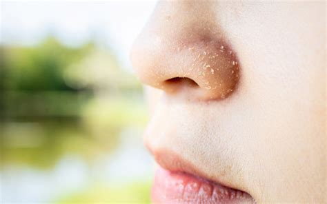 How To Get Rid Of Dry Nose Skin In The Summer Season