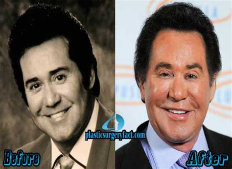 Wayne Newton Facelift Before and After - Plastic Surgery Facts