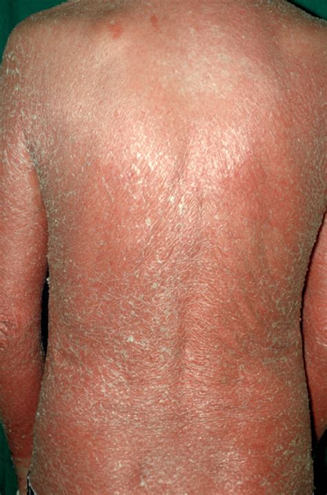 Diagnosis And Management Of Psoriasis And Psoriatic Arthritis In Adults