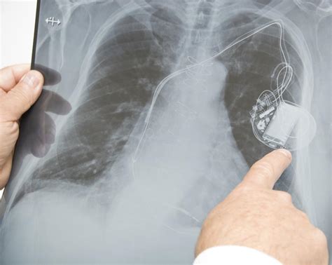 Heart Pacemaker Surgery Purpose Procedure And Risks