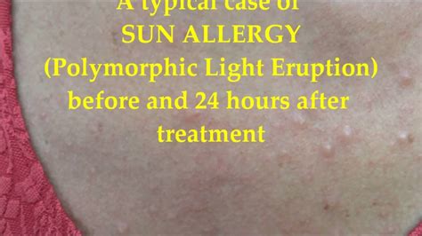 A Case Of Sun Allergy Before And 24 Hours After Treatment Youtube