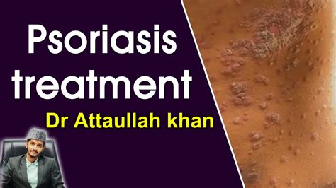 Psoriasis Treatment By Dr Attaullah Khan Youtube