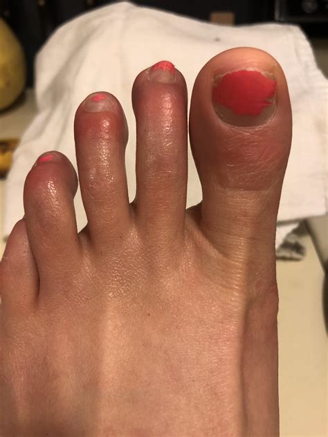 Each Winter My Toes On Both Feet Get Red Swollen And Sometimes