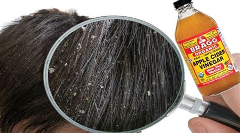 How To Use Apple Cider Vinegar For Dandruff Ostomy Lifestyle