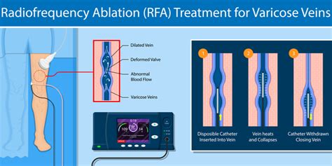 Radiofrequency Vein Ablation Varicose Vein Treatments Vein Specialists