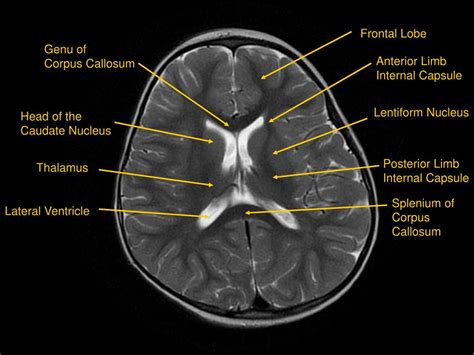 Ppt Mri Of Brainhead And Neck Powerpoint Presentation Free Download