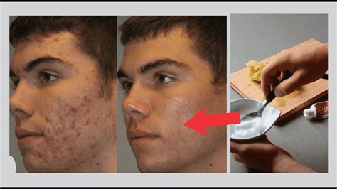 Como Acabar Com As Espinhas Acabe Com As Espinhas Como Tratar Acne Como