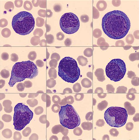 Atypical Lymphoid Cells Circulating In Blood In Covid 19 Infection