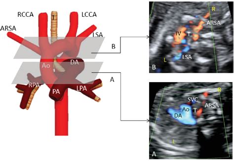 Figure From Fetal Aortic Arch Anomalies Key Sonographic Views For