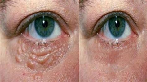 Incredilble I Removed All Milia Just By Lemon White Bupms Under Eyes