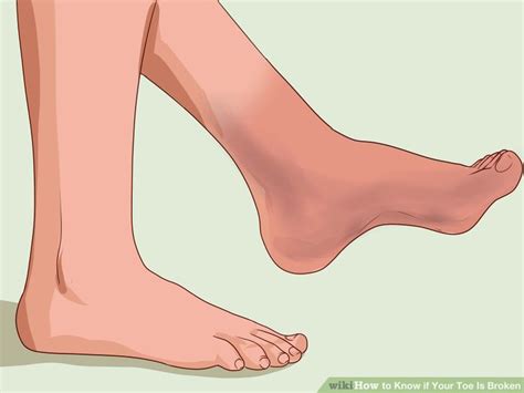 Sometimes—it depends on the type of break. How to Know if Your Toe Is Broken