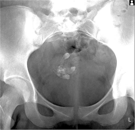 Mature Cystic Teratoma In A Year Old Girl With Lower Back Pain For
