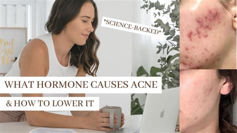 Can Coffee Cause Hormonal Acne How Coffee Affects Your Skin According To Science