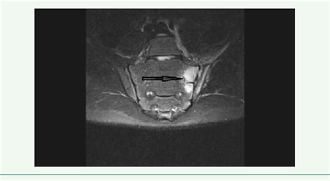 Figure 2 From Iliopsoas Abscess With Septic Arthritis Of The Hip