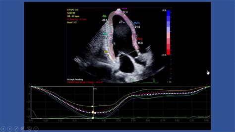 Strain Echocardiography By Speckle Tracking And Tissue Doppler Part I