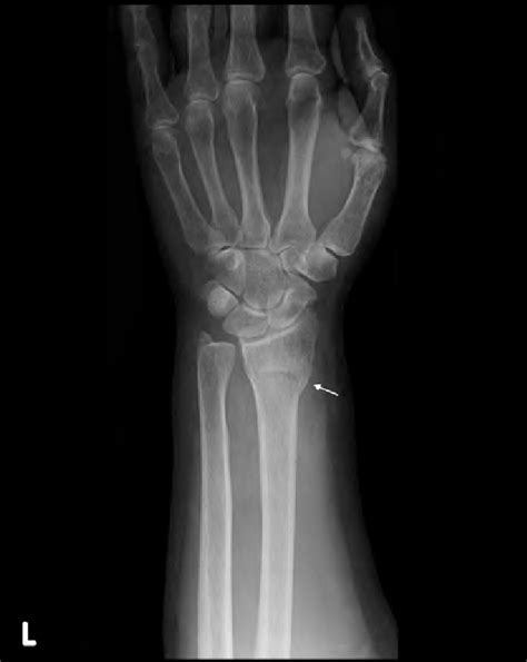 An X Ray Showing Left Distal Radius Fracture Of The Patient Arrow
