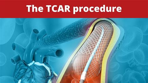 The Tcar Procedure Youtube