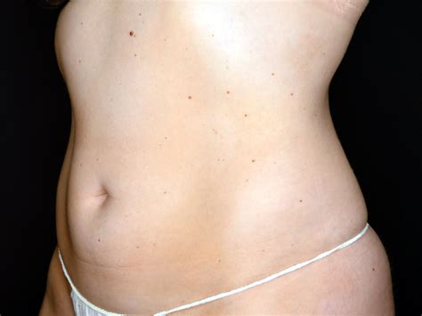 before and after coolsculpting — cpw vein and aesthetic center