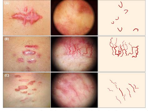 Pdf Keloids And Hypertrophic Scars Characteristic Vascular