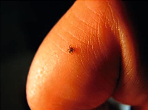 Prevention Of Tick Borne Diseases An Overview British Journal Of