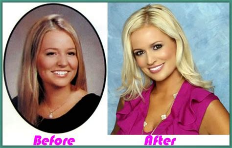 Emily Maynard Plastic Surgery Before After Breast Imp