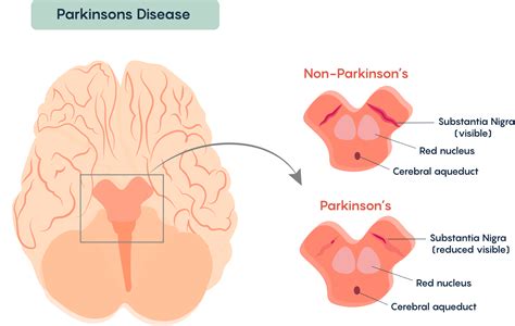 What Neurons Are Affected By Parkinsons Disease