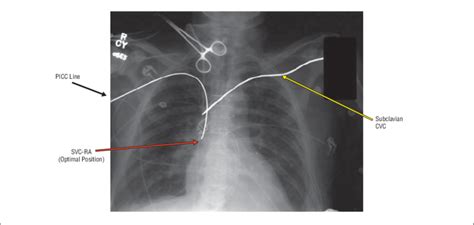 Vascular Access Device Tip Positions Cvc Indicates Central Venous