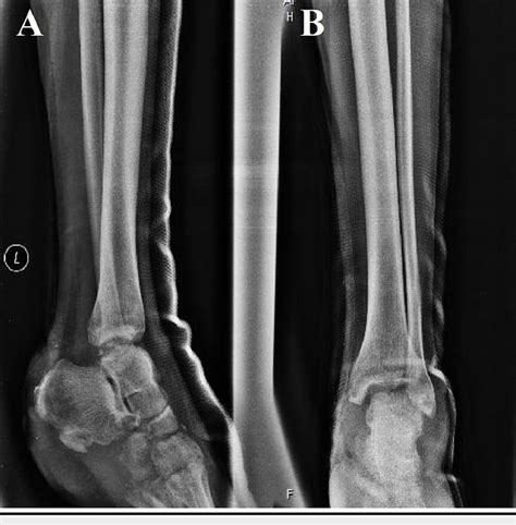 Anteroposterior A And Lateral B Radiograph Displaying The Avulsion