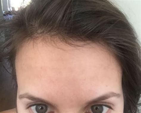 How I Cleared My Tiny Bumps On Forehead Once Forehead Bumps