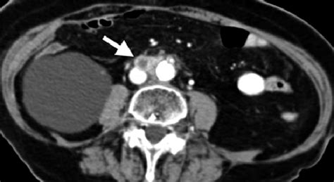Axial Contrast Enhanced Ct Image In A Patient With Endometrial Cancer