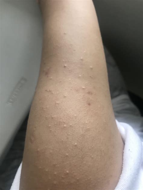 Skin Concern There Are White Bumps On My Both My Arms