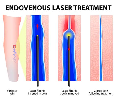 Evlt Endovenous Laser Treatment Top Medics Poland