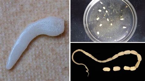 Parasites Under The Skin In Humans Symptoms How To Get Rid Of Worms