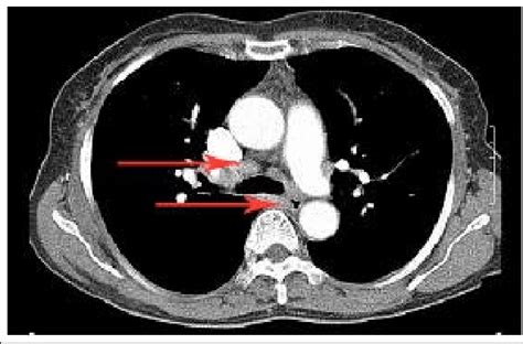 Chest Computed Tomography Showed Bilateral Hilar Lymphadenopathy Red