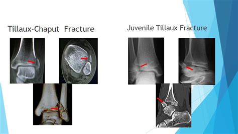 特殊类型的踝关节骨折（六）：tillaux Chaput Fracture 好医术早读文章 好医术 赋能医生守护生命