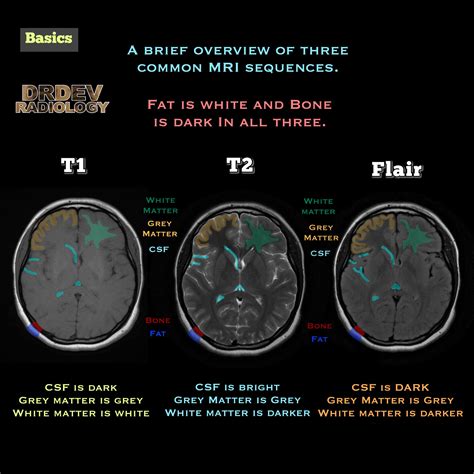 Mri Brain Sequence Comparison T1 Vs T2 Vs Flair T1 Grepmed