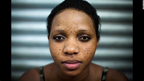 Bobriski Side Effects Of Skin Bleaching Daily Advent Nigeria