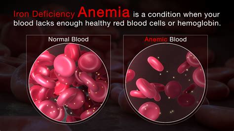 Iron Deficiency Anemia Symptoms Causes And Treatment Scientific