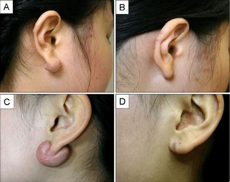 A Patient 4s Earlobe Keloid Before Treatment And B 6 Months After Download Scientific
