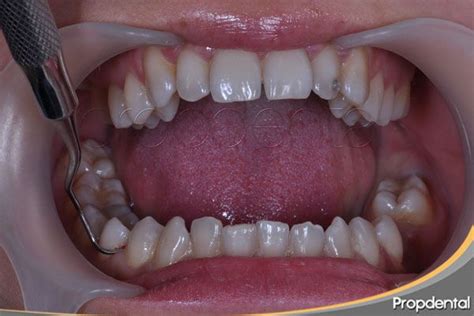 ¿qué Es El Curetaje Dental Curetaje Dental Por Cuadrantes Dental