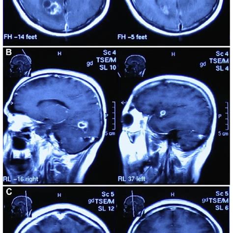 Contrast Enhanced T1 Weighted Brain Magnetic Resonance Imaging Shows