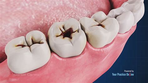 Dental Cariology 7