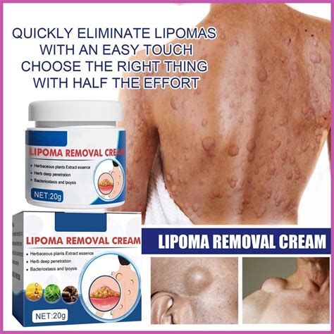 Lipoma Removal Cream Herbal Extract Care Fat Bulges Lump Remove