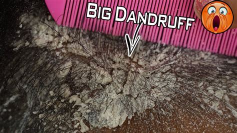 Scratching Flakes Off Scalp Really Big Dandruff Flakes On Back Of