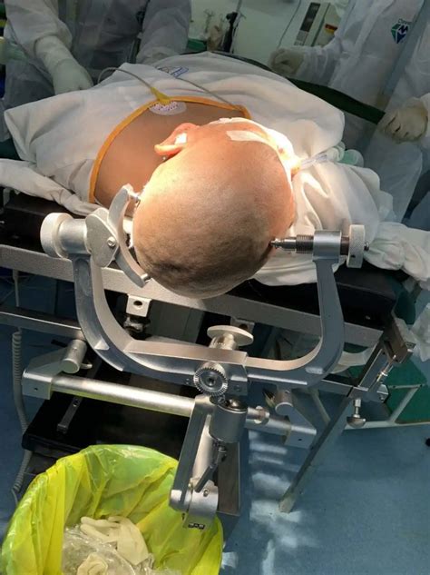 He Ii Neurosurgery Brain Surgery Three Point Skull Clamp 3 Pin Head