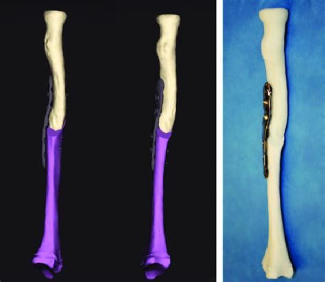 B Virtual Corrective Osteotomy Of The Radius And Simulation Of Plate